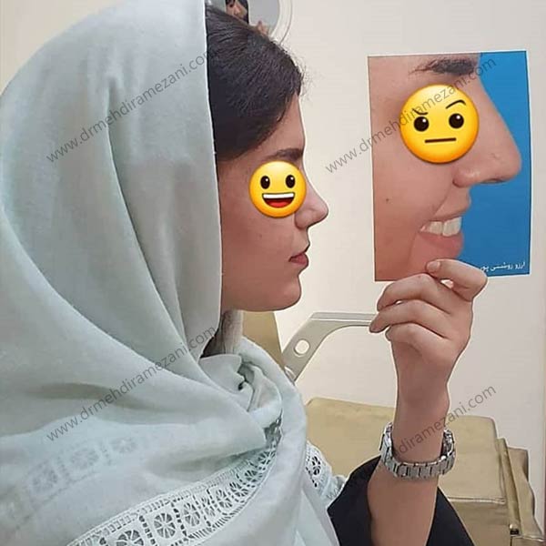 عکس قبل و بعد عمل بینی ارزان در مشهد