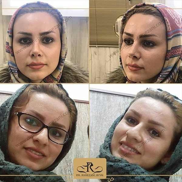 جراحی بینی گوشتی در مشهد