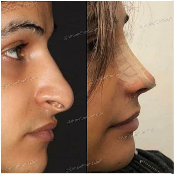 عکس قبل و بعد عمل بینی در مشهد