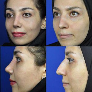 قبل و بعد از عمل بینی استخوانی در مشهد